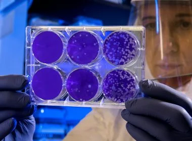 Cientistas anunciam primeira mulher possivelmente curada do HIV