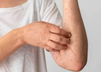 Sesab emite alerta após aumento de casos de catapora na Bahia