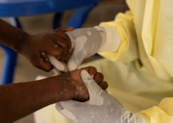 Saúde negocia compra de 25 mil doses de vacina contra mpox